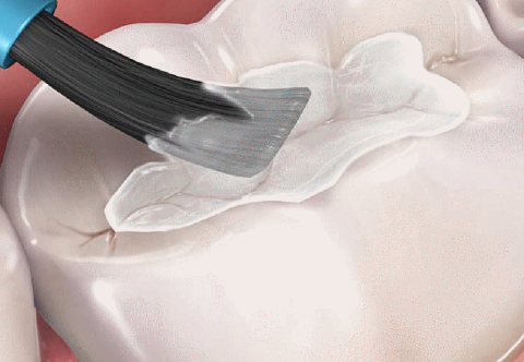 TRÁM BÍT HỐ RÃNH, tìm hiểu tất cả những gì cần biết